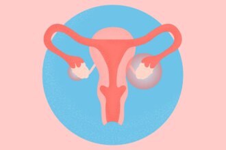 What Is Polyendocrine Metabolic Ovarian Syndrome (PMOS), Formerly Known as PCOS?