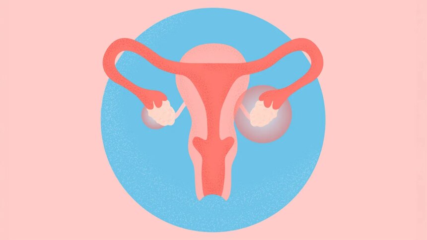 What Is Polyendocrine Metabolic Ovarian Syndrome (PMOS), Formerly Known as PCOS?