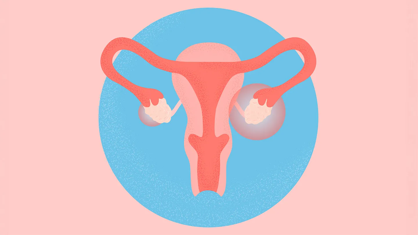 What Is Polyendocrine Metabolic Ovarian Syndrome (PMOS), Formerly Known as PCOS?